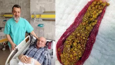 Taşla dolu safra kesesi alındı - Kırıkkale Haber, Son Dakika Kırıkkale Haberleri Taşla dolu safra kesesi alındı - Kırıkkale Haber, Son Dakika Kırıkkale Haberleri