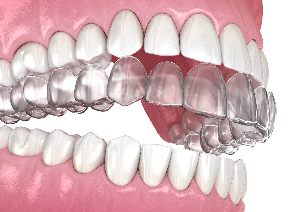 Şeffaf Plak Tedavisi İle Bakımlı Ve Düz Dişler - Kırıkkale Haber, Son Dakika Kırıkkale Haberleri