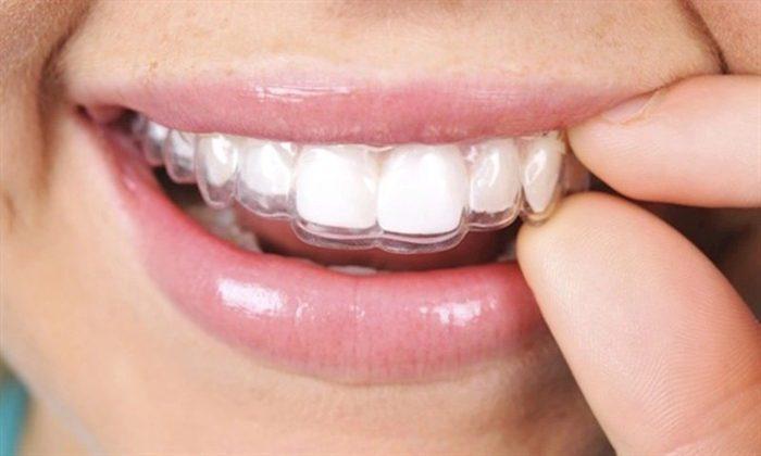 Invisalign Tedavisi Ne Kadar Sürer? - Kırıkkale Haber, Son Dakika Kırıkkale Haberleri